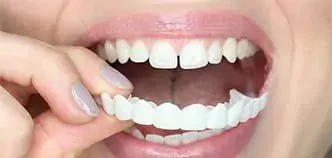 Виниры Dent Expert (Дент Эксперт)